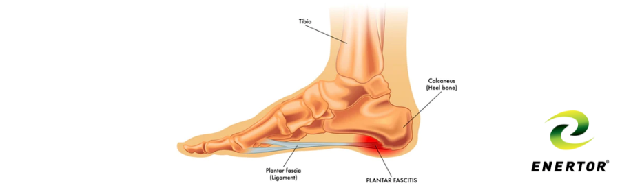 Pain near heel on sale bone